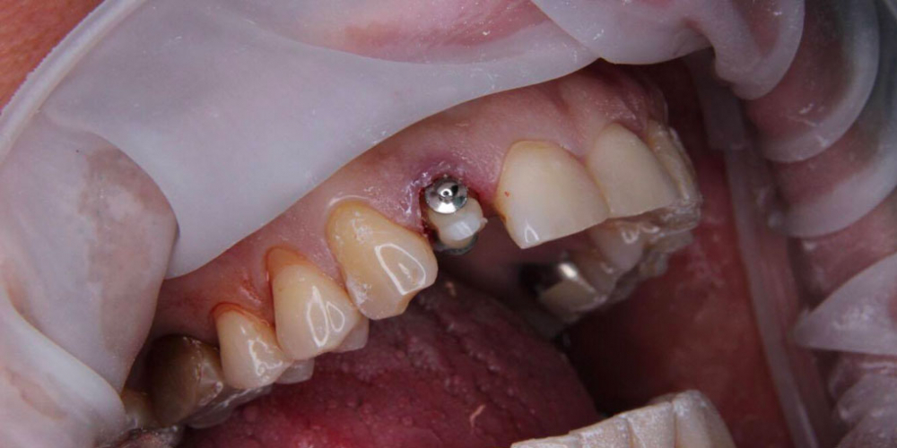 Спасение зуба и восстановление коронкой - фото №6