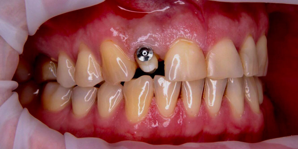 Спасение зуба и восстановление коронкой - фото №8