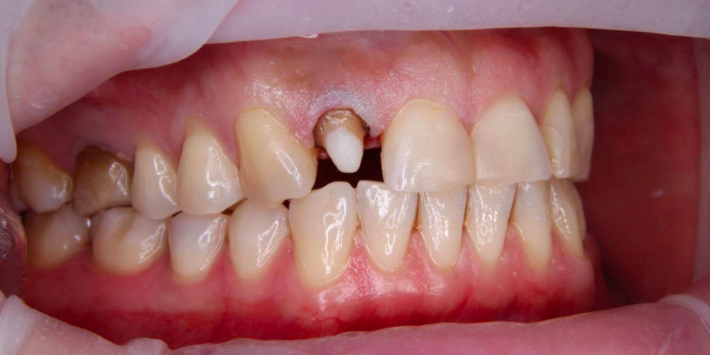 Спасение зуба и восстановление коронкой - фото №2