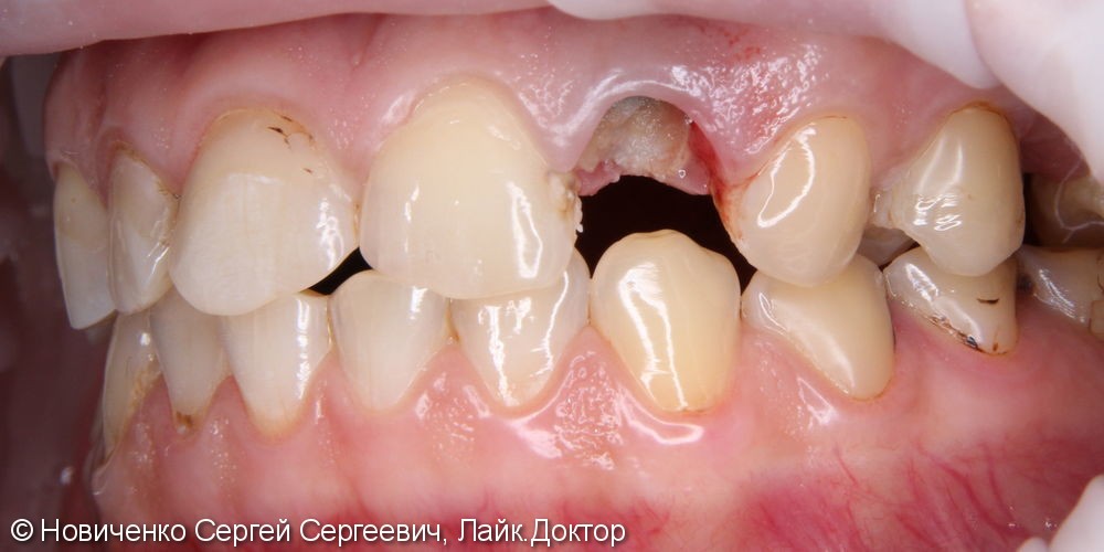 Экструзия 22го зуба с последующим протезированием - фото №2