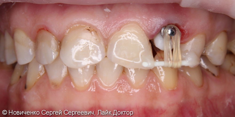 Экструзия 22го зуба с последующим протезированием - фото №4