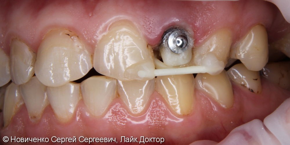 Экструзия 22го зуба с последующим протезированием - фото №5