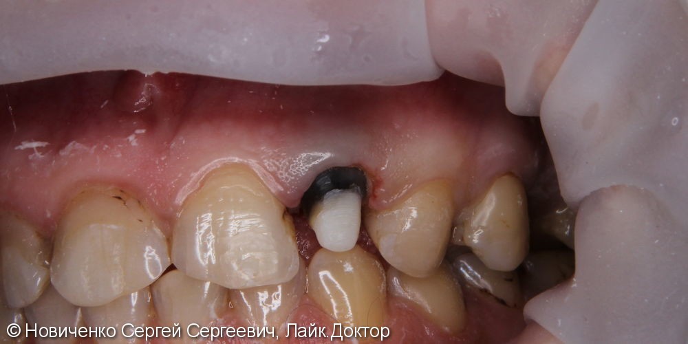 Экструзия 22го зуба с последующим протезированием - фото №6