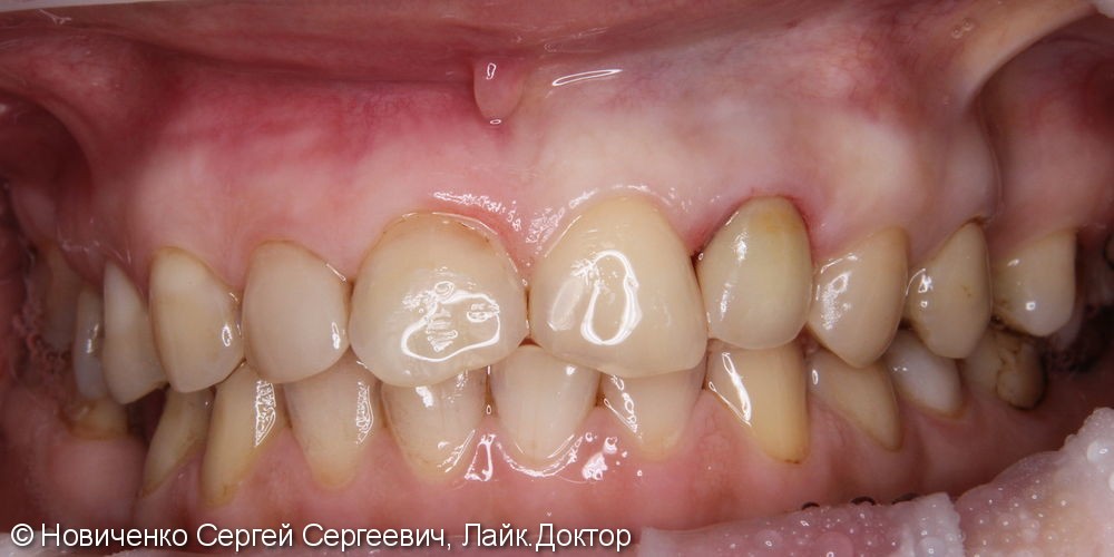 Экструзия 22го зуба с последующим протезированием - фото №8