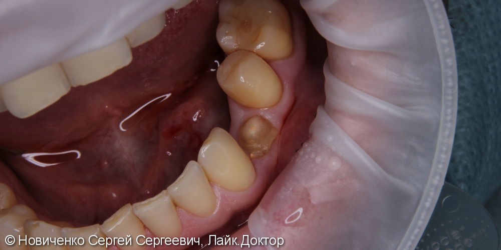 Восстановление зуба установкой имплантата и коронкой, до и после - фото №1