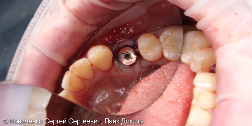 Восстановление зуба установкой имплантата и коронкой, до и после - фото №2