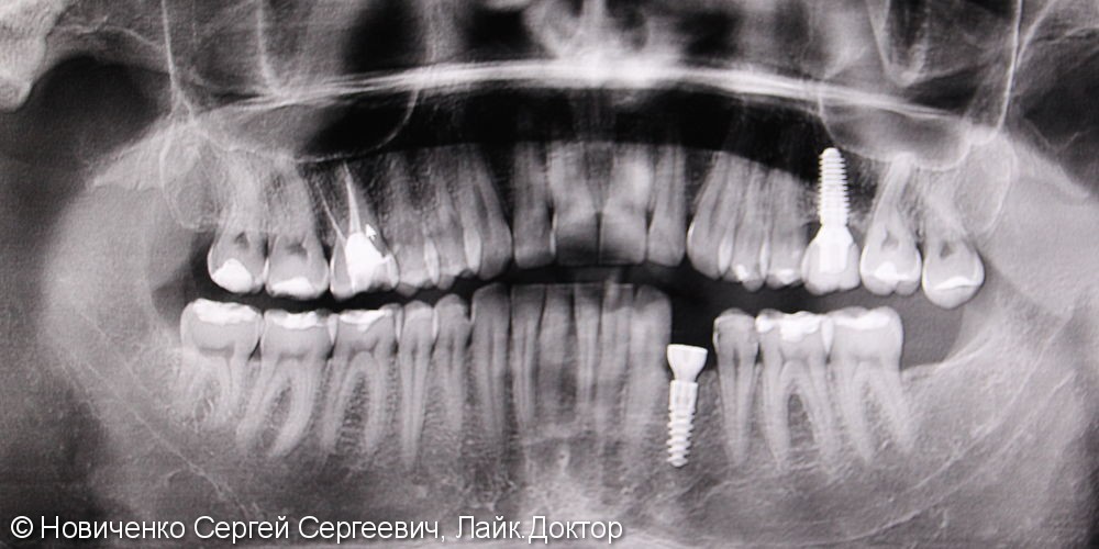 Восстановление зуба установкой имплантата и коронкой, до и после - фото №3