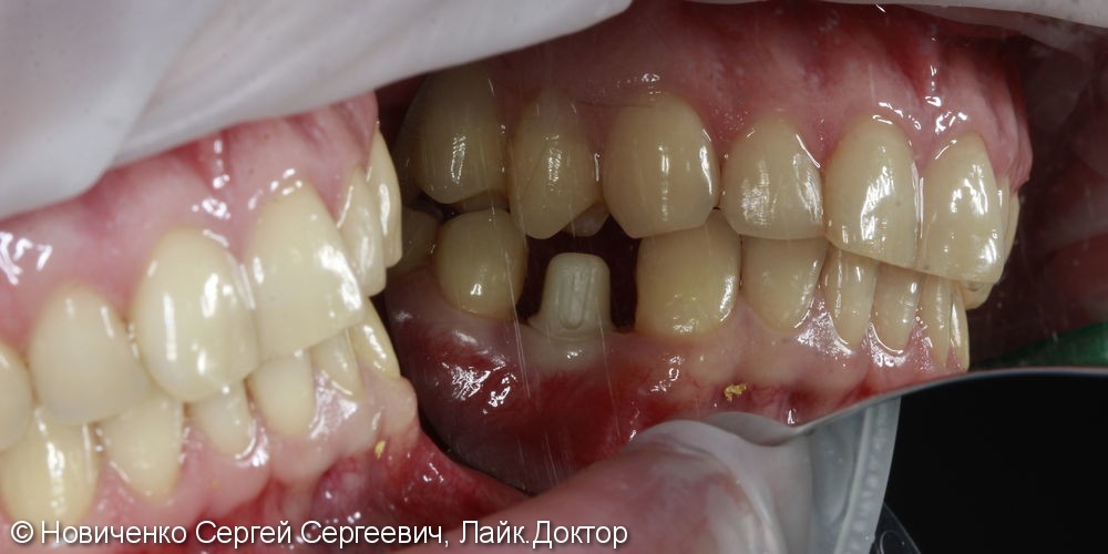 Восстановление зуба установкой имплантата и коронкой, до и после - фото №5