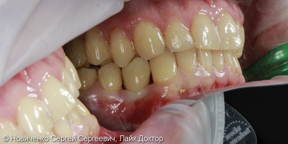 Восстановление зуба установкой имплантата и коронкой, до и после - фото №6