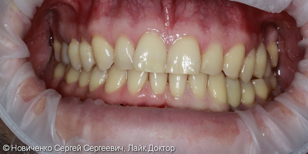 Восстановление зуба установкой имплантата и коронкой, до и после - фото №7