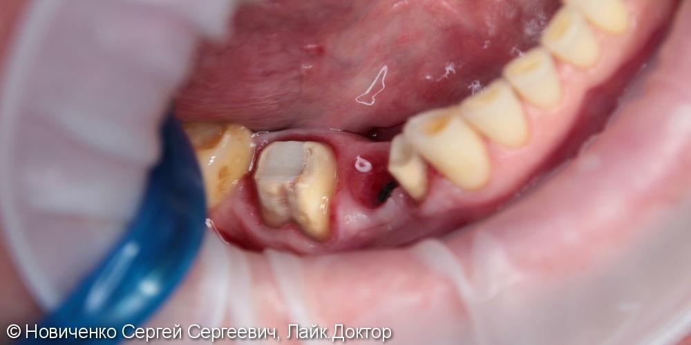Протезирование 3 зубов подряд, вживление имплантата, до и после - фото №1