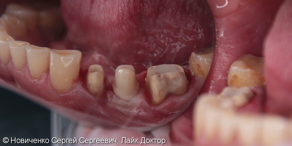 Протезирование 3 зубов подряд, вживление имплантата, до и после - фото №3
