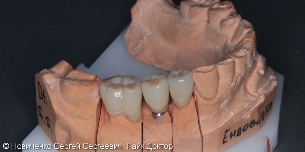 Протезирование 3 зубов подряд, вживление имплантата, до и после - фото №4
