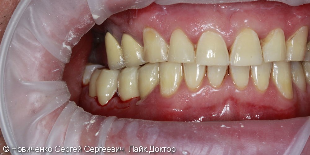 Протезирование 3 зубов подряд, вживление имплантата, до и после - фото №5
