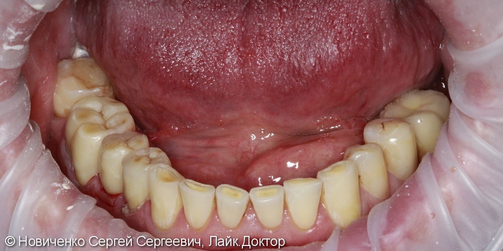 Протезирование 3 зубов подряд, вживление имплантата, до и после - фото №6
