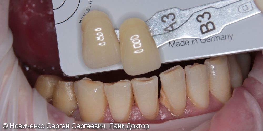 Протезирование 44, 45 зубов коронками из оксида циркония - фото №1