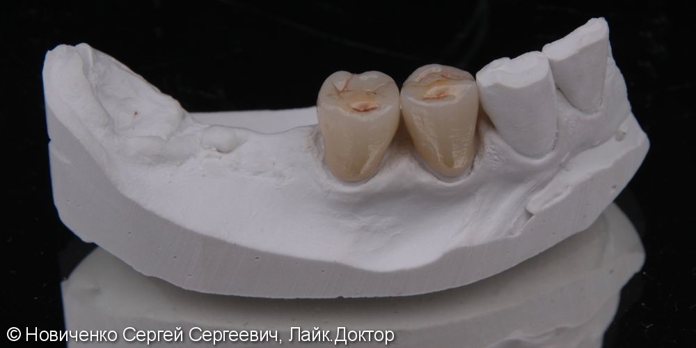 Протезирование 44, 45 зубов коронками из оксида циркония - фото №2