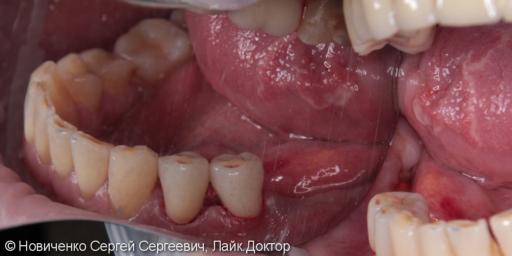 Протезирование 44, 45 зубов коронками из оксида циркония - фото №3