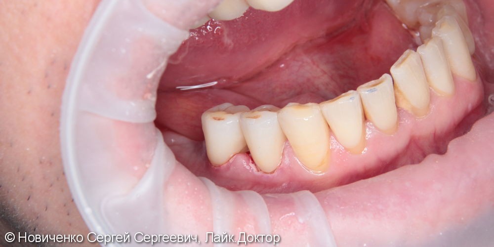 Протезирование 44, 45 зубов коронками из оксида циркония - фото №4