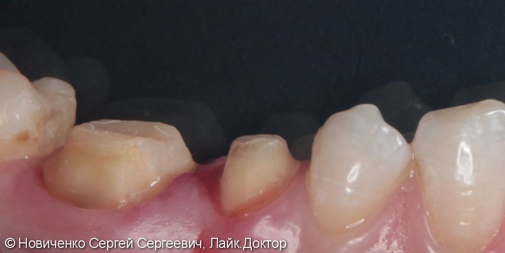 Протезирование зубов коронками, до и после лечения - фото №1