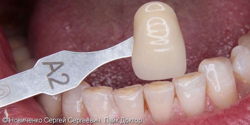 Протезирование зубов коронками, до и после лечения - фото №4