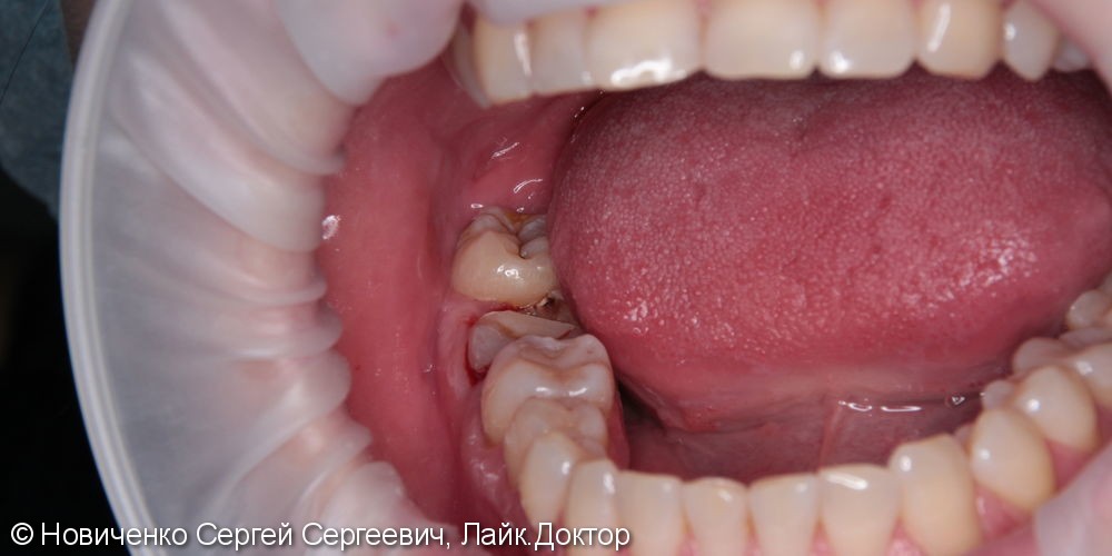 Реимплантация зуба соседнего зуба, до и после - фото №1