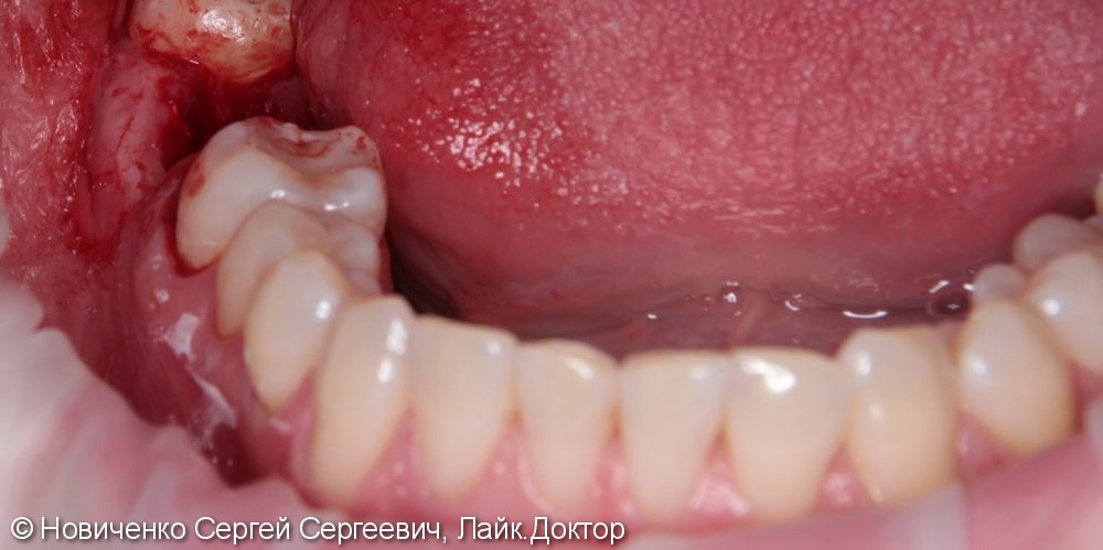 Реимплантация зуба соседнего зуба, до и после - фото №2