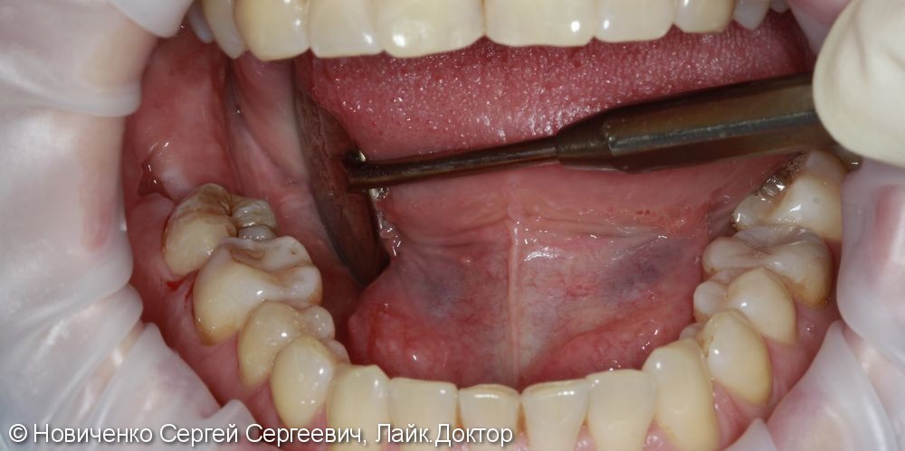 Реимплантация зуба соседнего зуба, до и после - фото №4