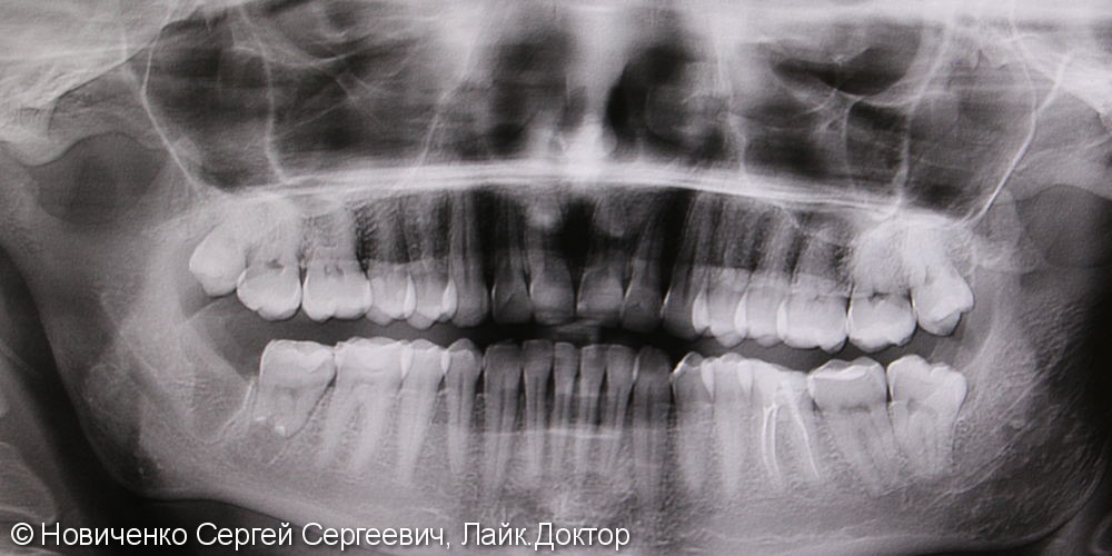 Реимплантация зуба соседнего зуба, до и после - фото №3