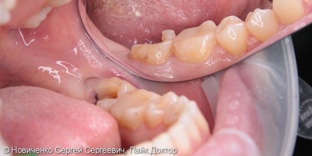 Протезирование 37 зуба, до и после - фото №1