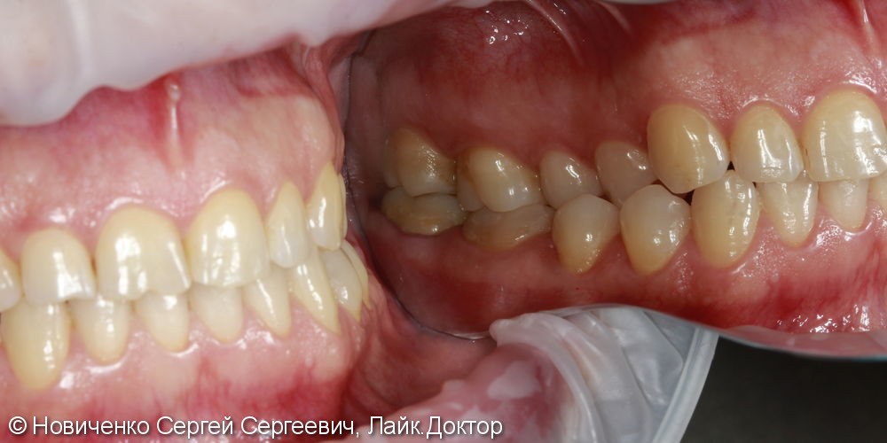 Протезирование 37 зуба, до и после - фото №3