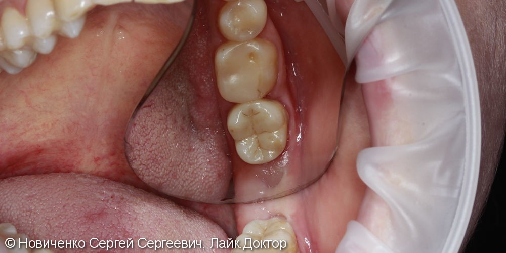 Протезирование 37 зуба, до и после - фото №4