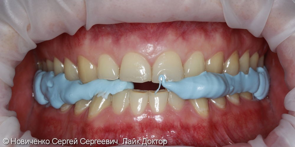Протезирование 32х зубов винирами и коронками - фото №2