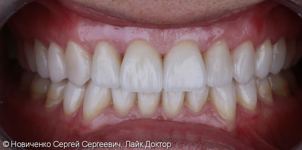 Протезирование 32х зубов винирами и коронками - фото №3