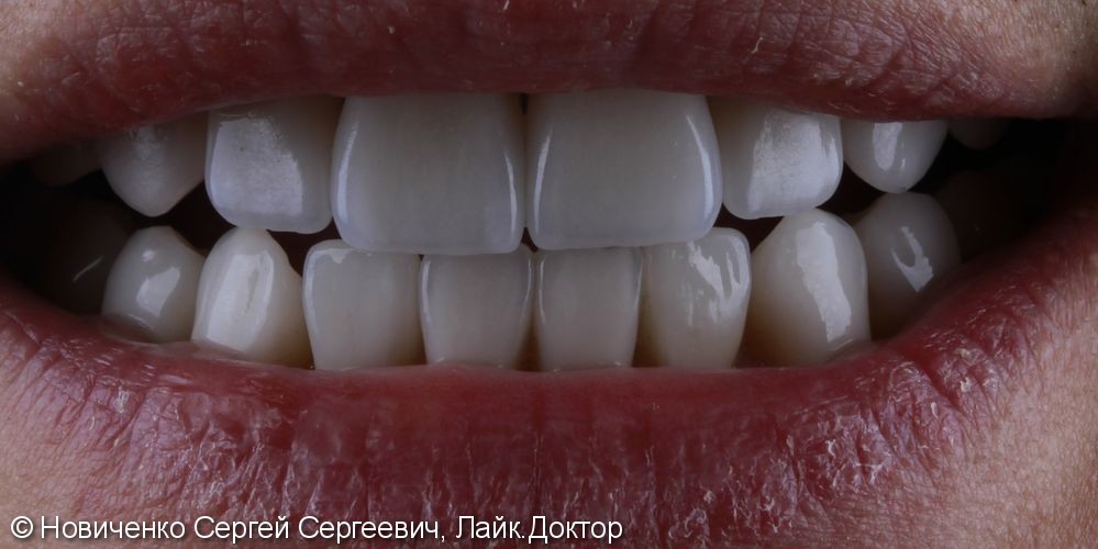 Протезирование 32х зубов винирами и коронками - фото №4