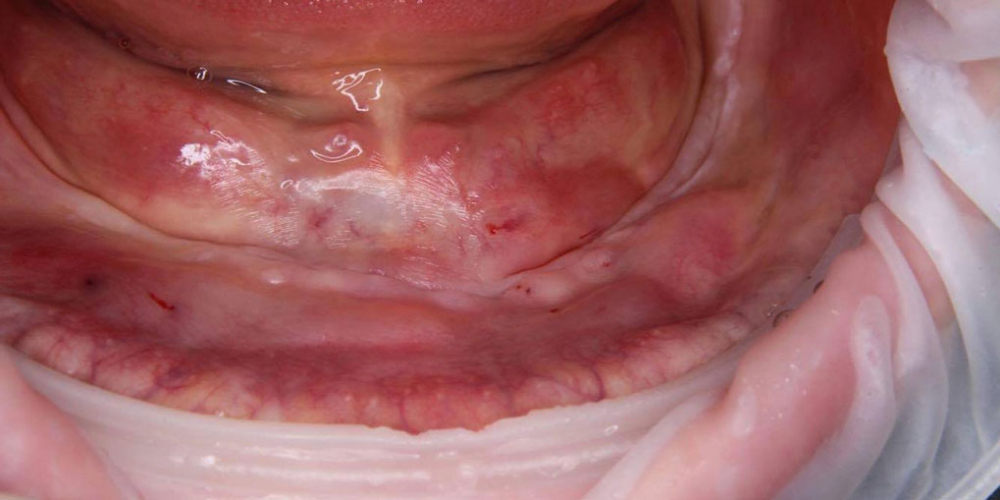 Телескопический бюгельный протез на нижнюю челюсть с опорой на имплантаты - фото №1