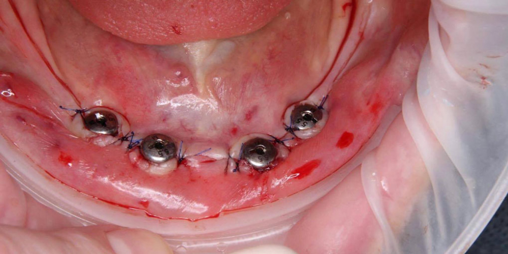 Телескопический бюгельный протез на нижнюю челюсть с опорой на имплантаты - фото №3