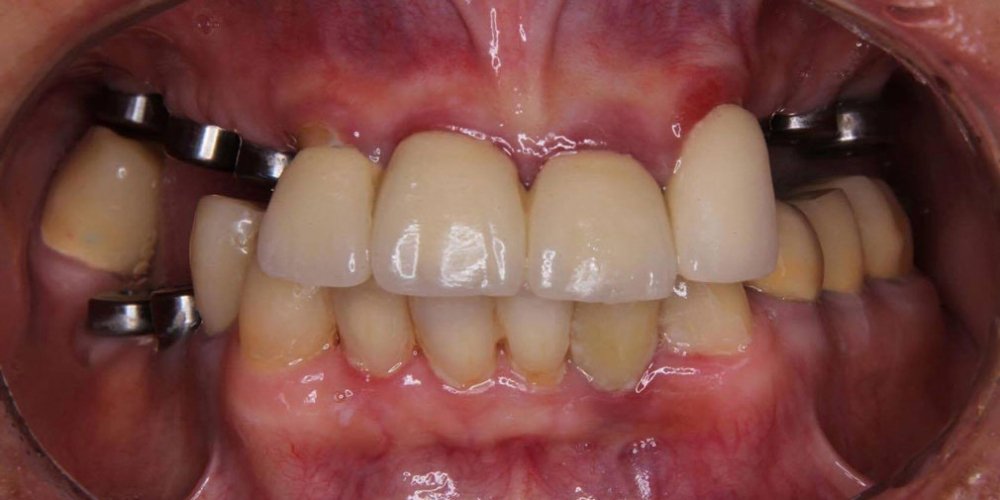 Операция комплексного восстановление зубов - фото №1