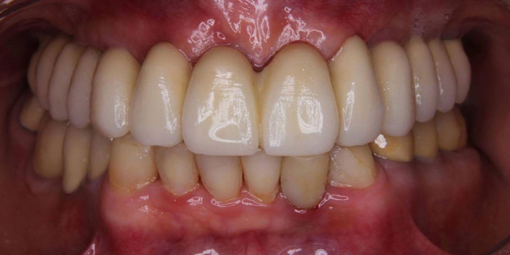 Операция комплексного восстановление зубов - фото №4