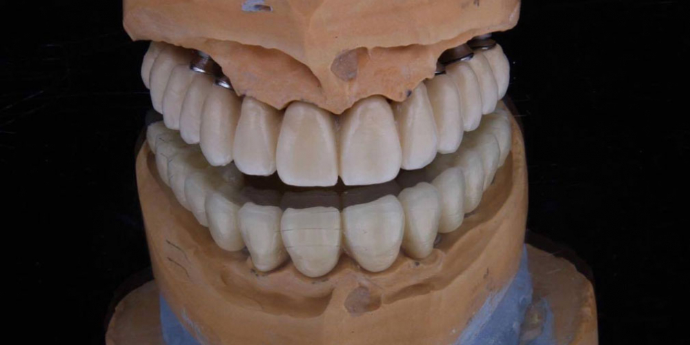 Операция комплексного восстановление зубов - фото №3