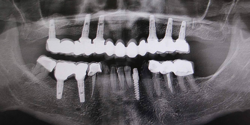 Операция комплексного восстановление зубов - фото №2