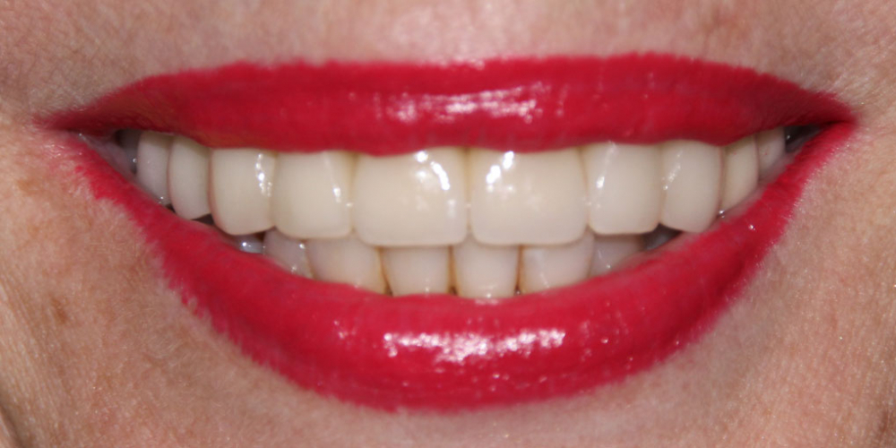 Жалобы на отсутствие зубов верхней челюсти - фото №3