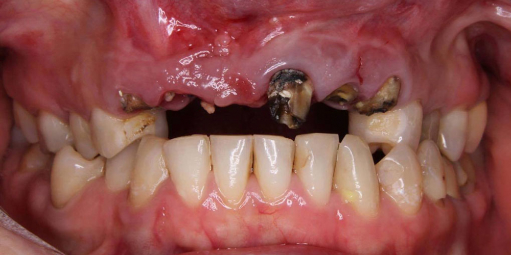 Восстановление передних зубов одномоментной имплантацией - фото №1