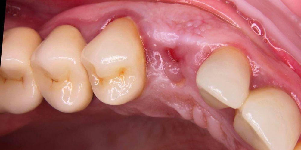 Пациент обратился с переломом коронки зуба - фото №1