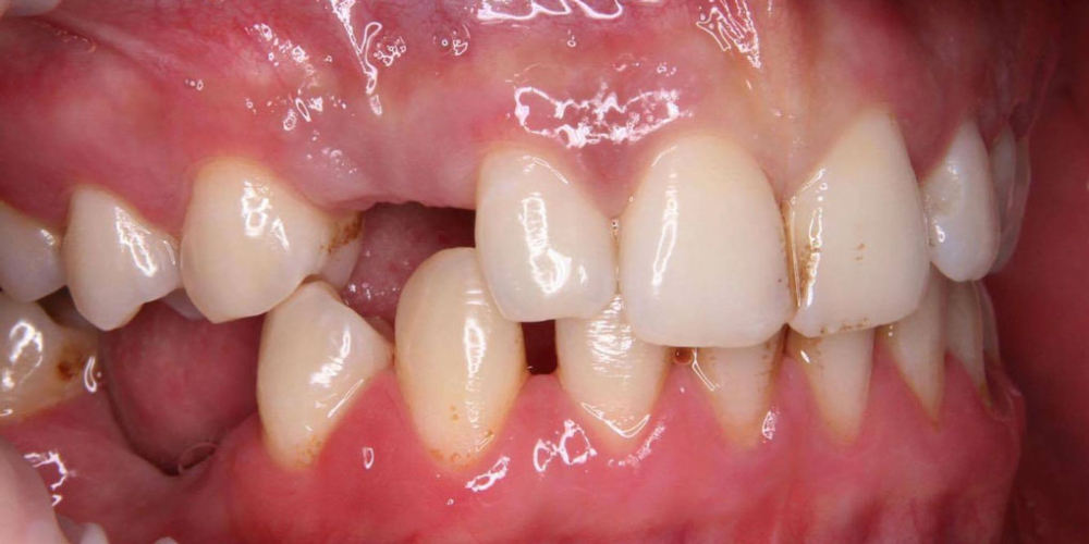 Восстановление утраченного зуба при помощи дентального импланта - фото №1