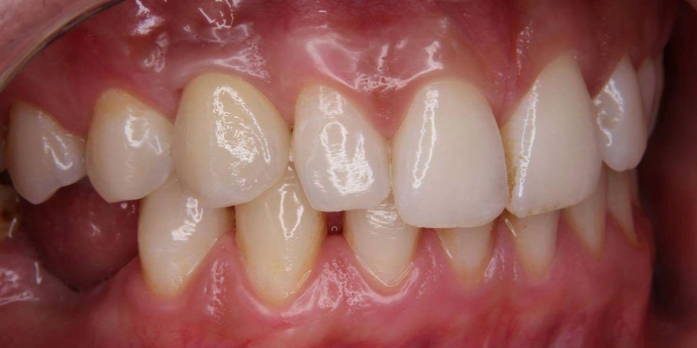 Восстановление утраченного зуба при помощи дентального импланта - фото №2