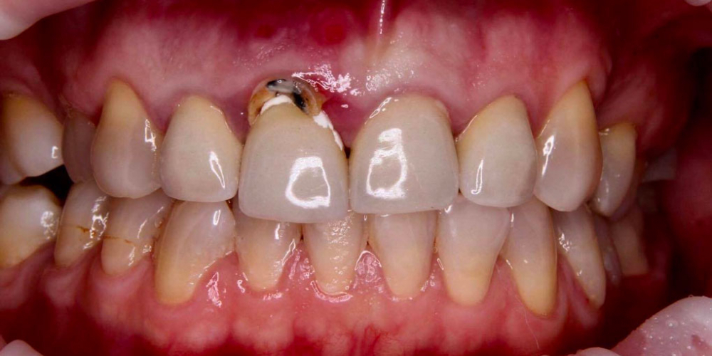 Результат имплантации зуба под ключ после перелома корня зуба - фото №1