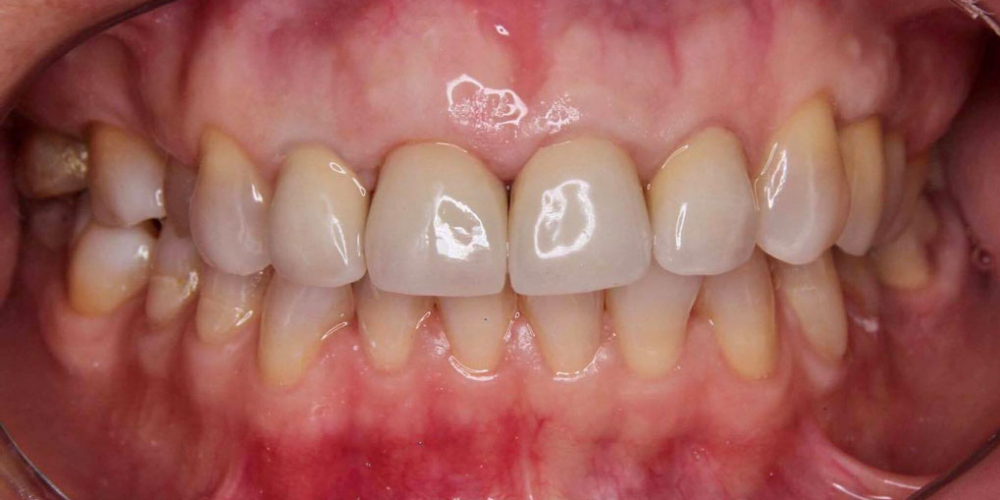 Результат имплантации зуба под ключ после перелома корня зуба - фото №7
