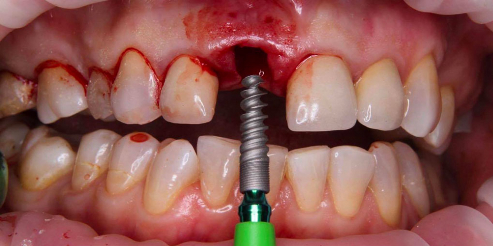 Результат имплантации зуба под ключ после перелома корня зуба - фото №3