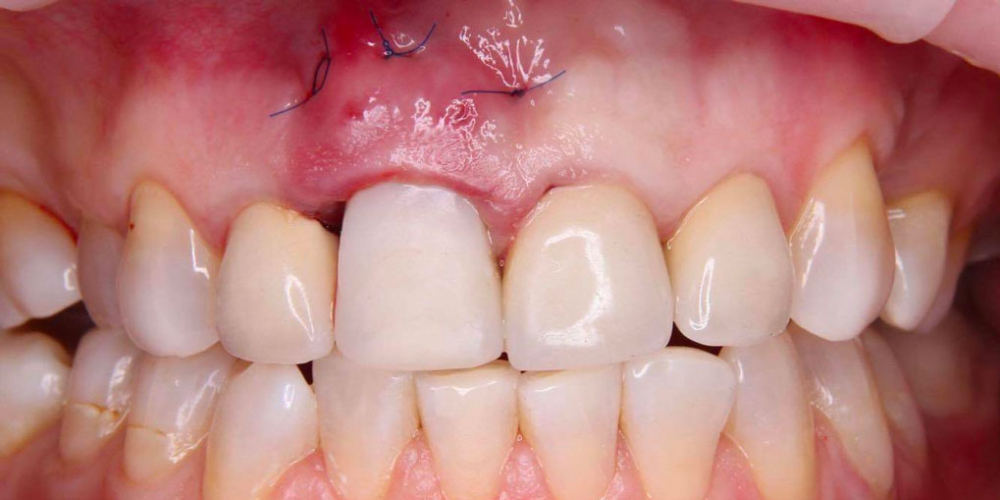 Результат имплантации зуба под ключ после перелома корня зуба - фото №4
